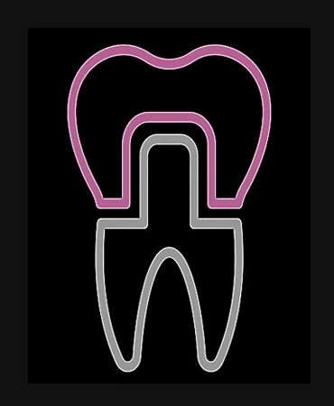 couronne dentaire cabinet dentaire Castellane Le Rouet 13006 Marseille