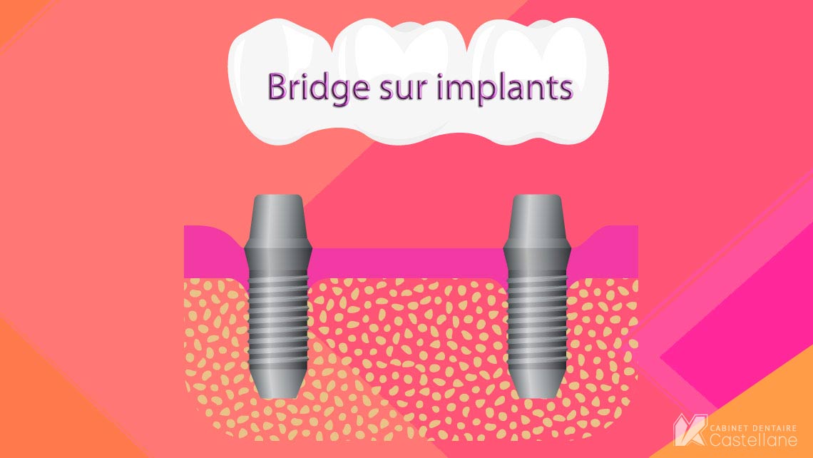 Pourquoi un bridge dentaire ? | Cabinet Dentaire Castellane 13006.