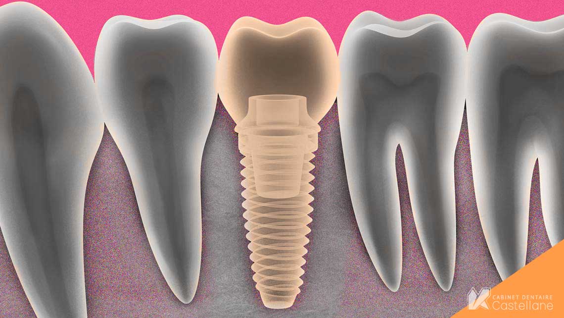 Qu'est-ce qu'un implant dentaire ? | Cabinet Dentaire Castellane 13006.