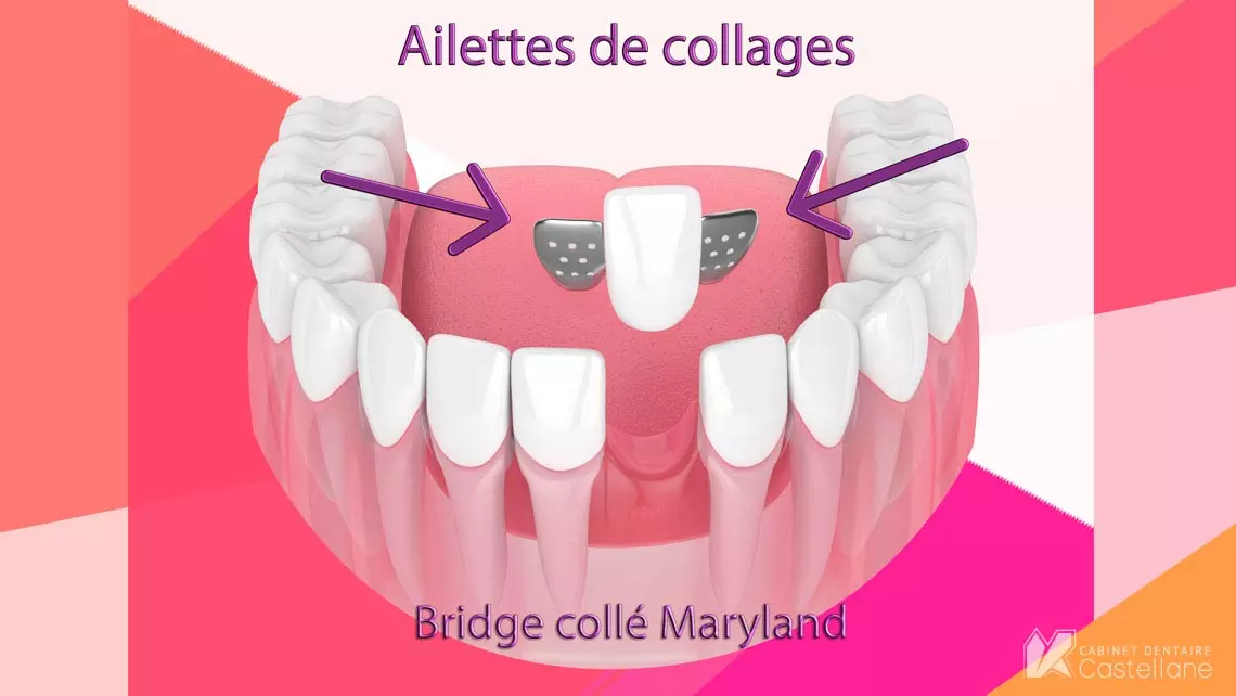 bridge dentaire ailette colle maryland marseille 13006 castellane le rouet